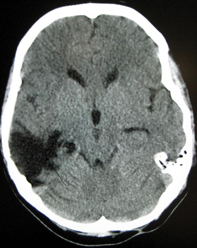 Pictured on the right is a CT scan after a traumatic brain injury.&#160;